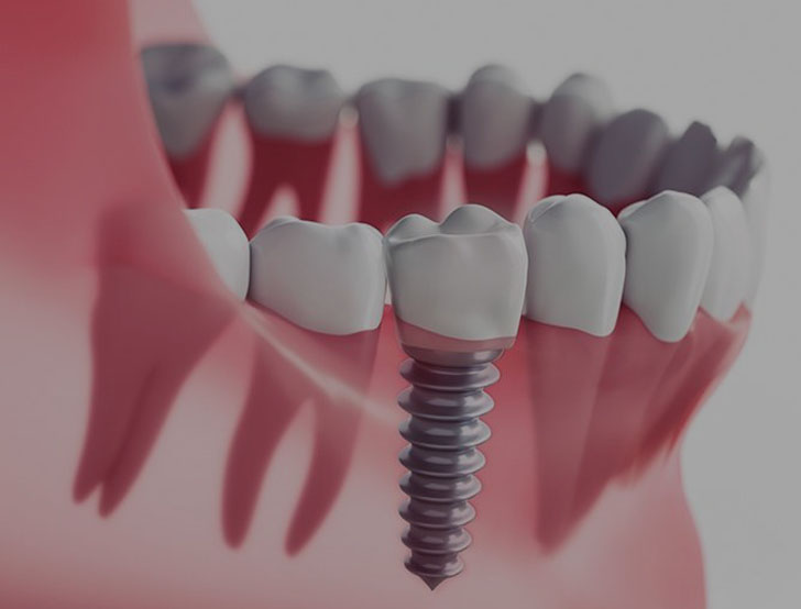 implant-dentaire-tunisie