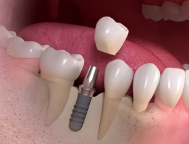pose-implant-dents-prix